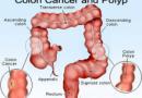 5 نشانه جدی بیماری سرطان روده‌ بزرگ 